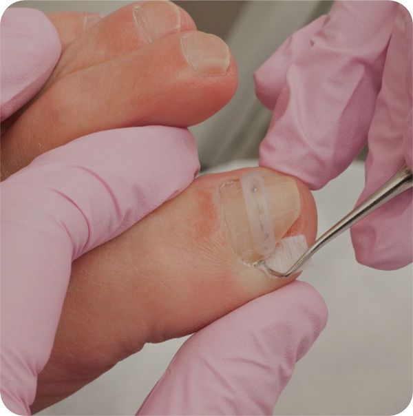 Cursos y talleres de Onicocriptosis 